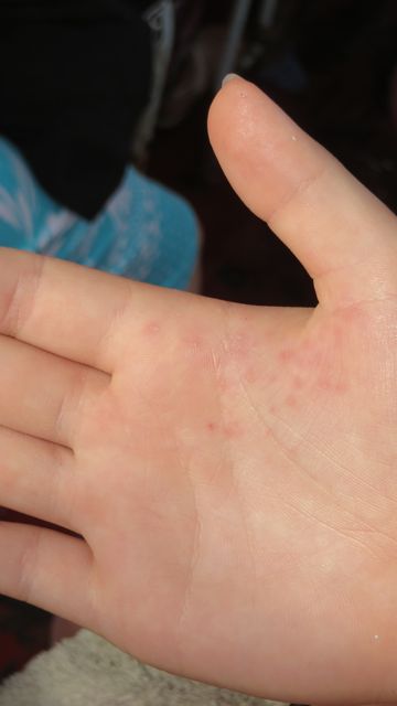 Pohjassa oli merisiilejä, Vilman kädestä juuri nypitty pois montakymmentä piikkiä!